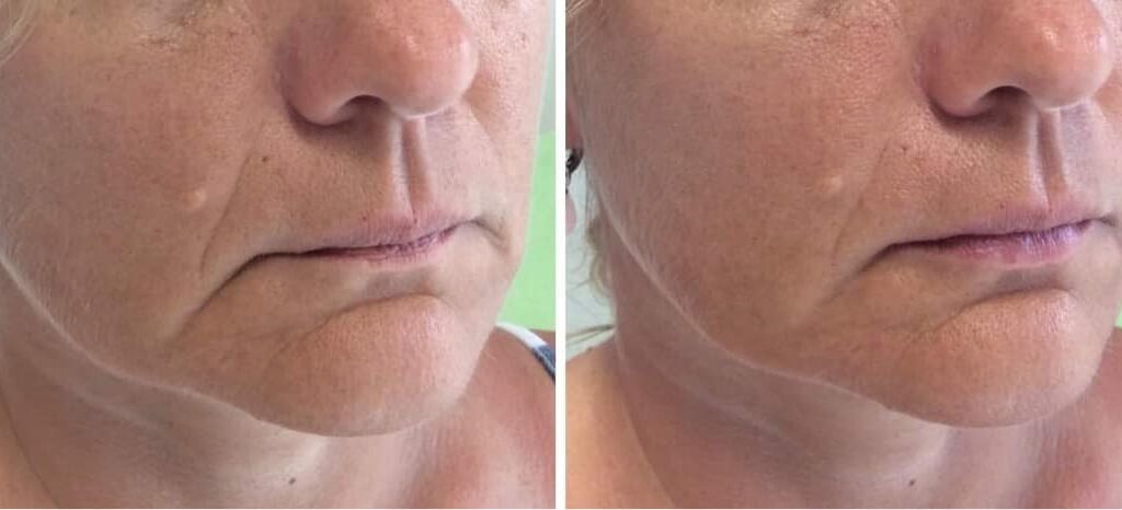 Kui palju on võimalik muuta 1 ml täitesüstiga?