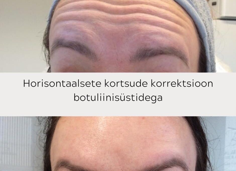 Enne ja pärast kurjusekortsu ning otsmikupiirkonna soovimatute kortsude ravi botuliinisüstidega
